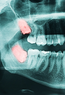 Xray of root canal work